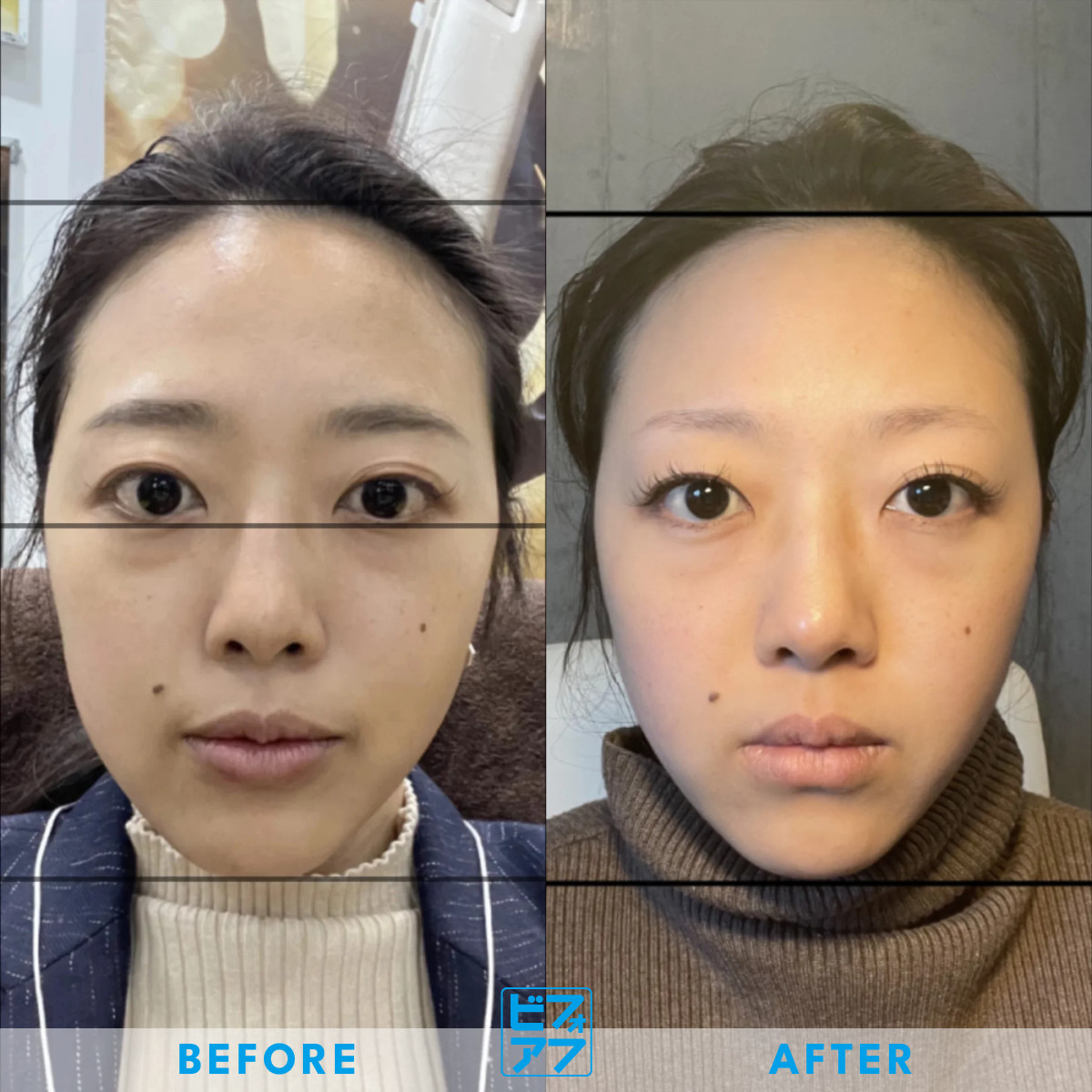 整形級に変わった小顔・顔の歪み矯正