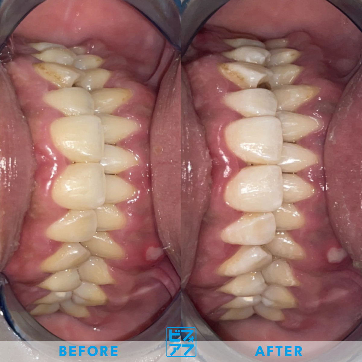 ホワイトニング